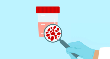 Image representing Haematuria (Blood in Urine) Explained
