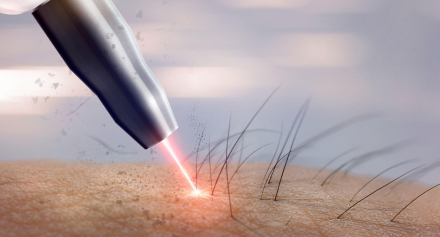 Image representing Laser Hair Removal: Your Guide to Smooth, Long-Lasting Results