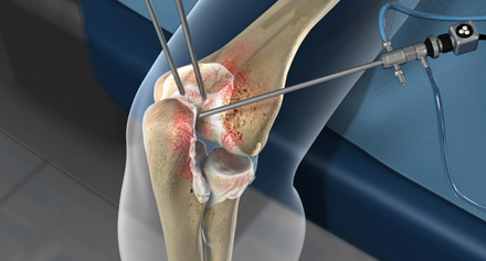Image representing Arthroscopy for Sports Injuries: A Minimally Invasive Approach