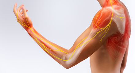 Image representing Understanding a Pinched Nerve: Causes, Symptoms & Treatments